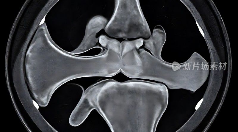 膝关节X光片展示