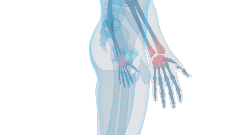 手腕 腱鞘炎手掌手臂手肘左手右手骨科骨头