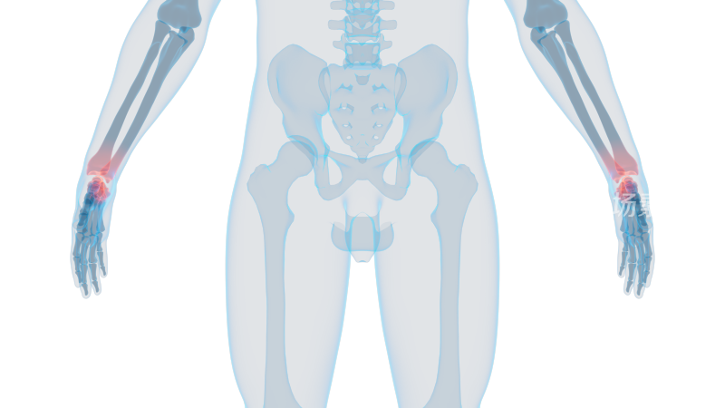 手腕 腱鞘炎手掌手臂手肘左手右手骨科骨头