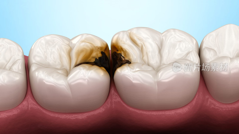 口腔治疗龋病蛀牙补牙种牙陶瓷牙坏牙