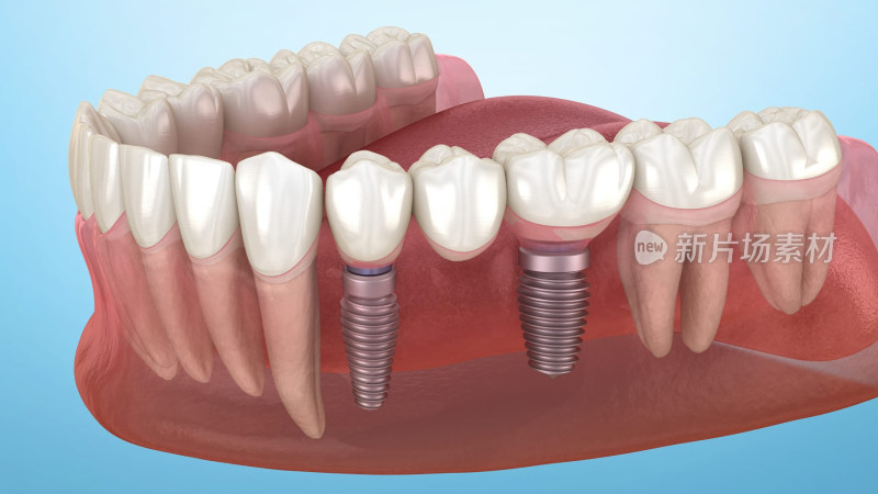 口腔医学牙齿牙体种植牙补牙烤瓷牙