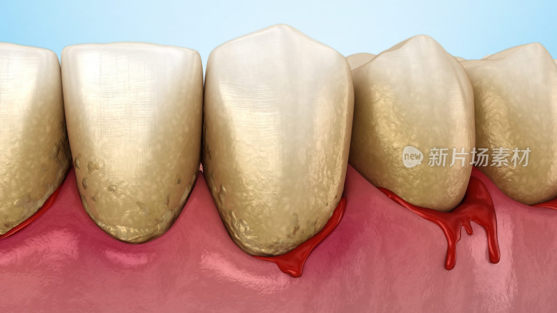 口腔疾病牙周病牙周炎牙齿疾病口腔健康