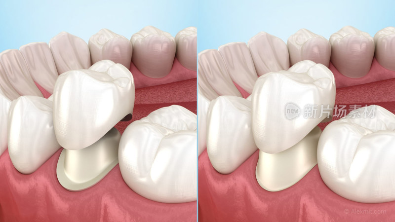 口腔医学牙齿牙套牙体假牙插图