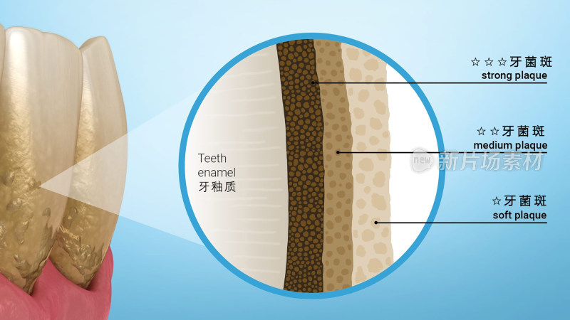 口腔医学口腔健康牙结石