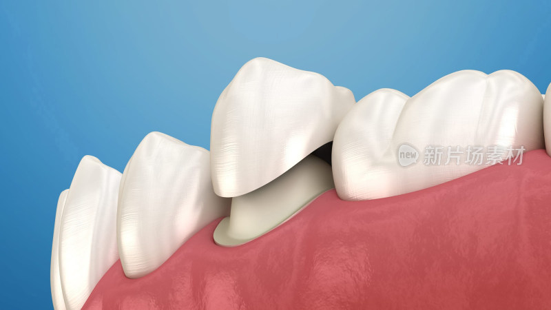 口腔医学牙齿牙套牙体假牙插图