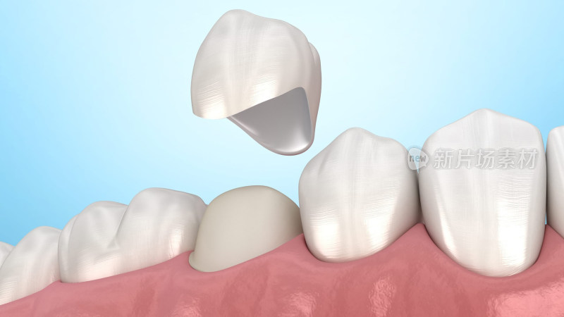 口腔医学牙齿牙套牙体假牙插图