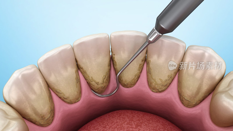 口腔医学口腔健康牙结石牙齿清洁
