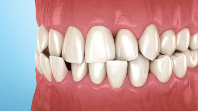 口腔矫正牙齿正畸牙套口腔整形