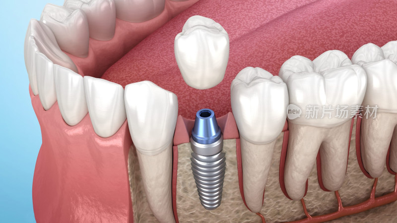 口腔医学牙齿牙体种植牙补牙烤瓷牙