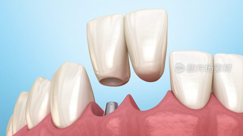 口腔医学牙齿牙体种植牙补牙烤瓷牙