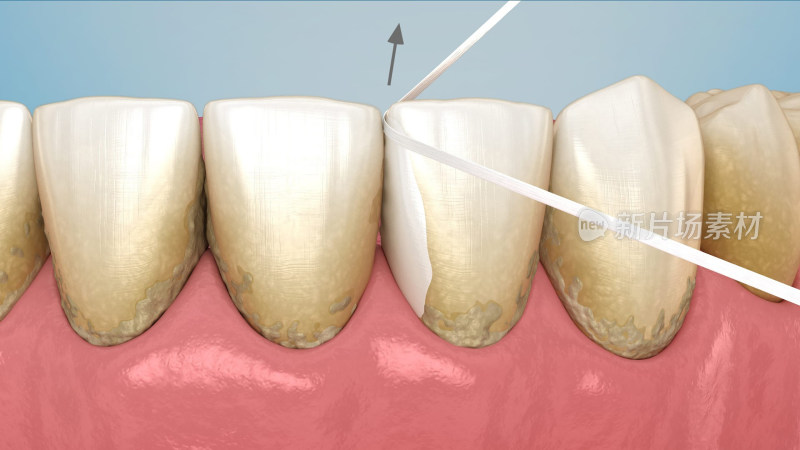 口腔医学口腔健康牙结石牙线刷牙牙齿清洁