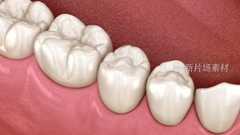 口腔治疗龋病蛀牙补牙种牙陶瓷牙坏牙