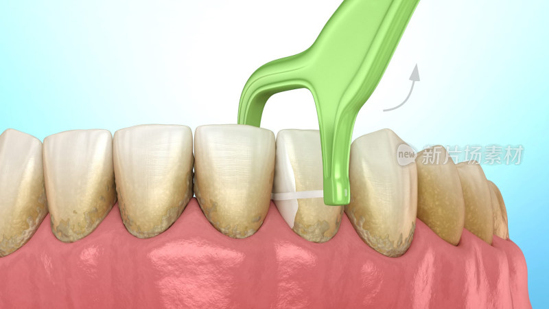 口腔医学口腔健康牙结石牙线刷牙牙齿清洁