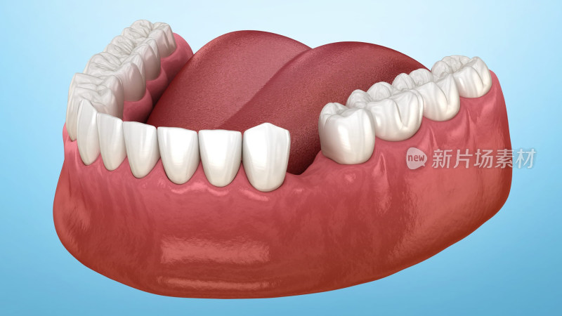 口腔医学牙科牙齿牙套假牙种植牙补牙