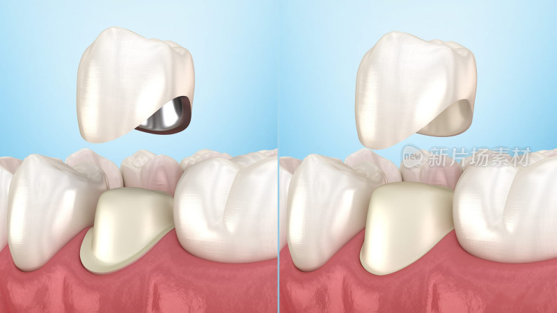 口腔医学牙齿牙套牙体假牙插图