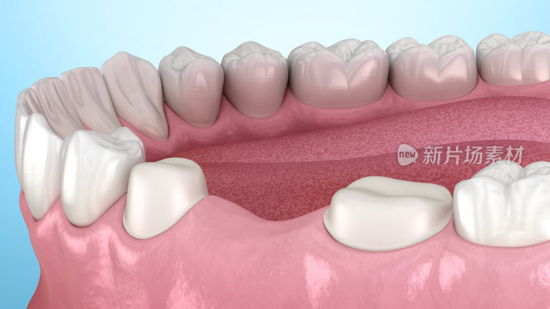 口腔医学牙科牙齿牙套假牙种植牙补牙
